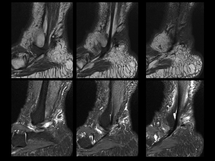 Figure 5 for case sural nerve ( RID7347 )